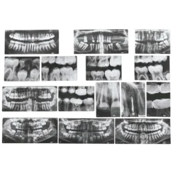 Dental X-Rays Set of 15 with Chart